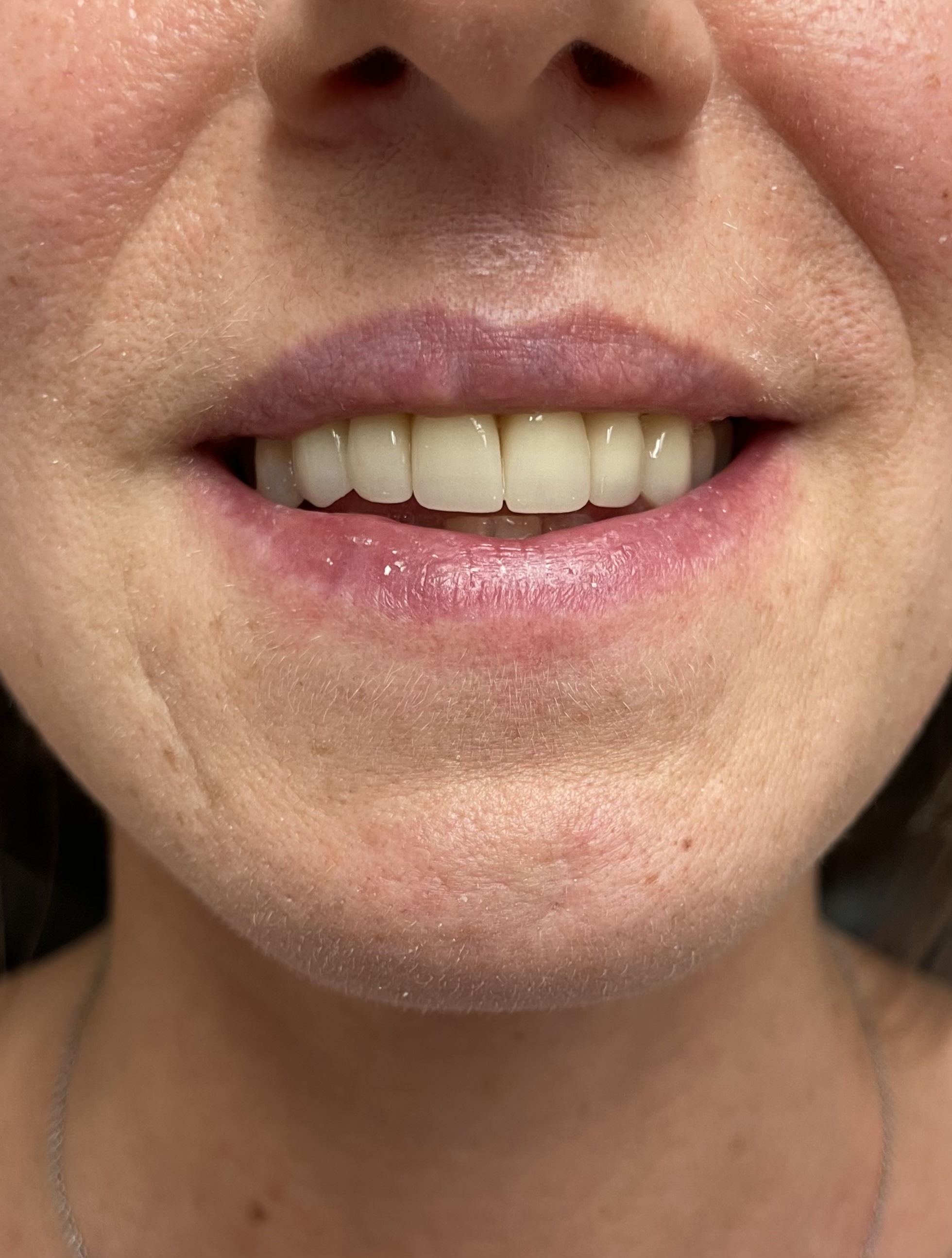 Композитне фасете, 21. март 2024, Дуњадент