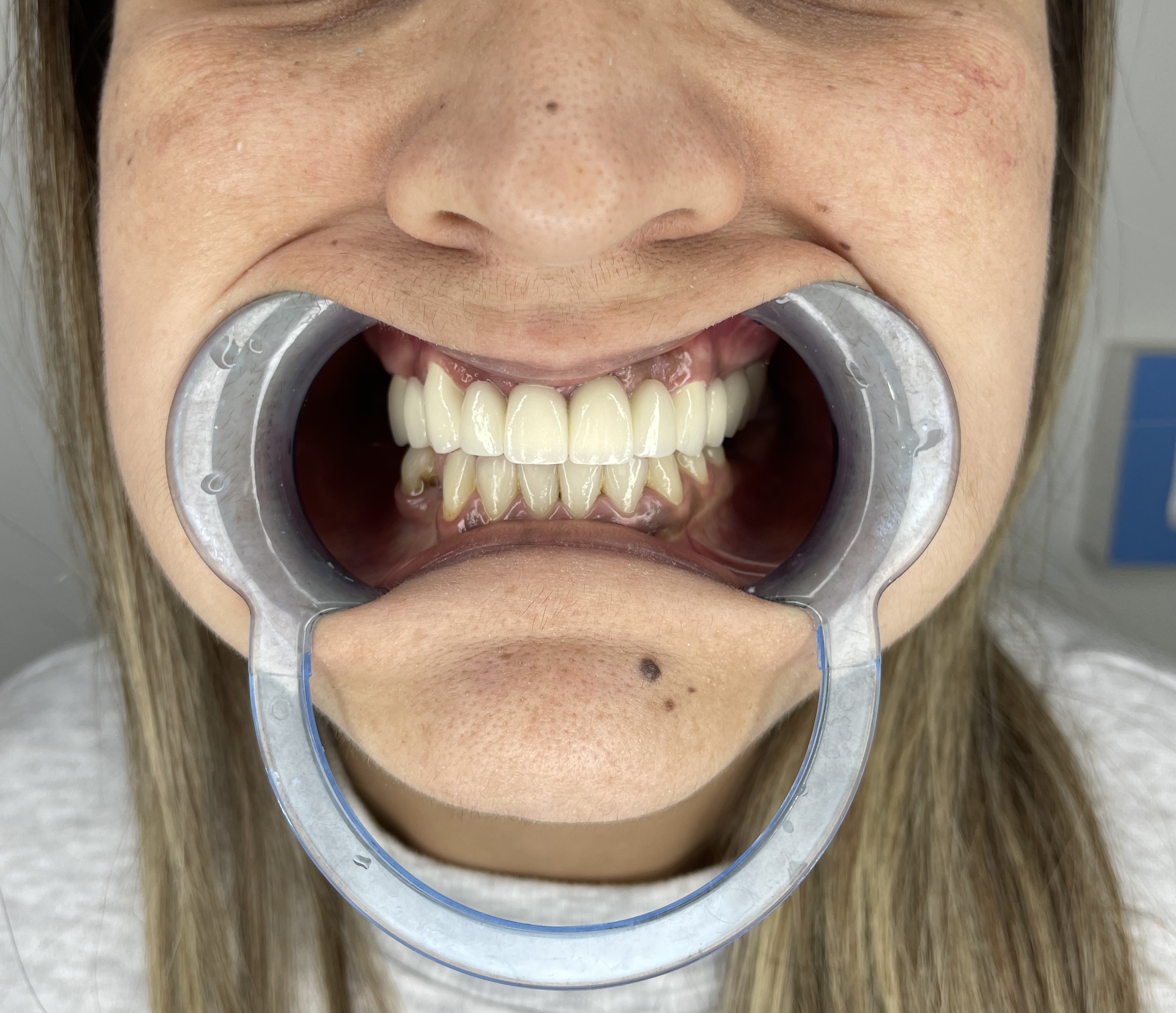 Композитне фасете, 21. март 2024, Дуњадент