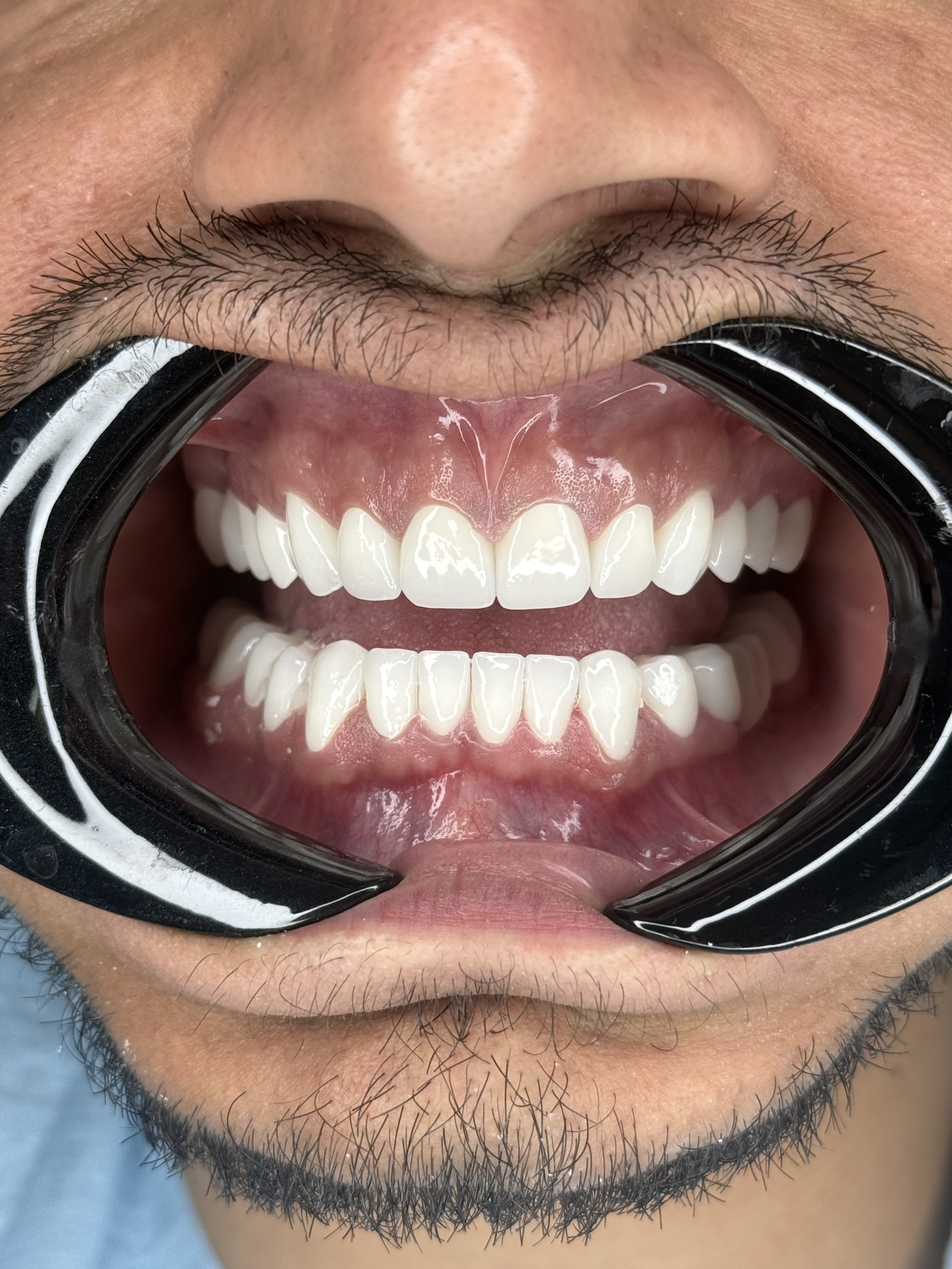 Композитне фасете, 21. март 2024, Дуњадент