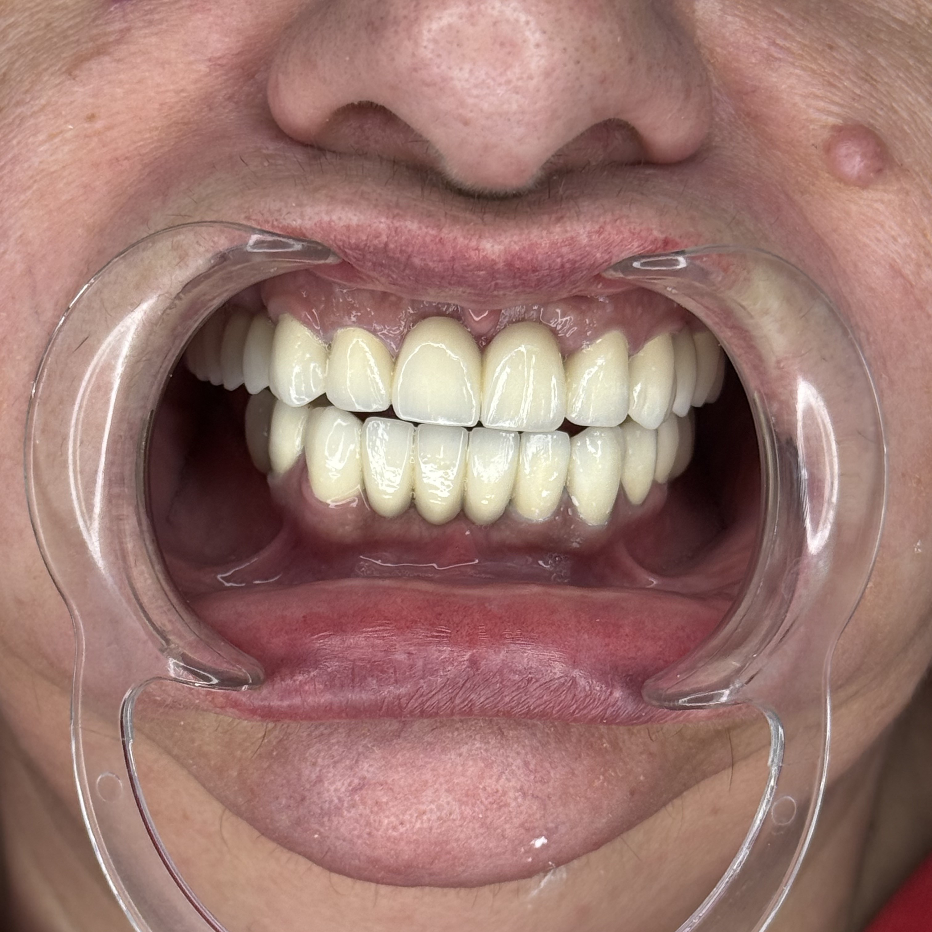 Композитне фасете, 21. март 2024, Дуњадент